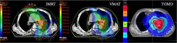 This Comparison Chart displays three axial CT slices of the thorax, illustrating radiation therapy dose distribution patterns for lung cancer using different treatment modalities: Intensity-Modulated Radiation Therapy (IMRT), Volumetric Modulated Arc Therapy (VMAT), and Helical Tomotherapy (TOMO). Each slice features a color-wash overlay representing dose intensity, with red indicating high-dose areas (Planning Target Volume/PTV) and blue representing low-dose regions. IMRT shows a spread-out, irregular distribution with significant intermediate-dose spillover. VMAT demonstrates improved conformity to the target volume but retains some low-dose extension. TOMO exhibits the highest conformity and steepest dose fall-off, characterized by tight, concentric rings of decreasing dose around the PTV. The image serves as a clinical teaching tool for medical physics and oncology to compare the precision and organ-at-risk sparing capabilities of modern external beam radiation techniques. Key anatomical landmarks include the lungs, mediastinum, and vertebrae, with the target localized in the left lung/hilar region.
