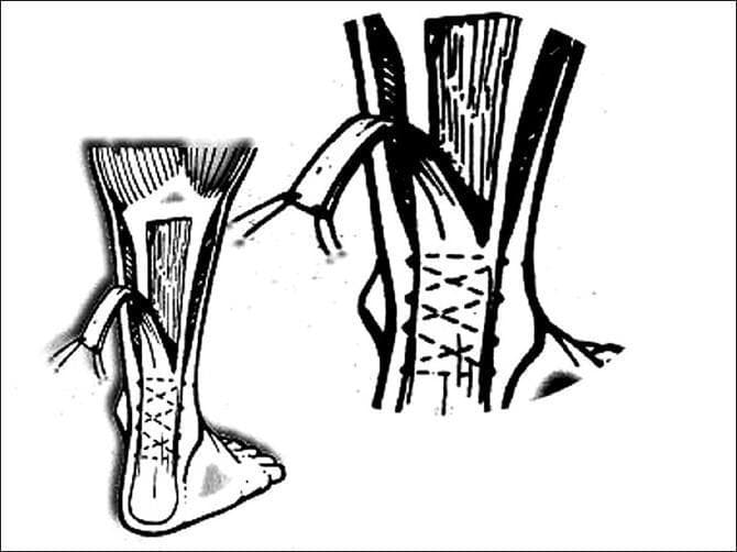 This medical illustration depicts a surgical technique for Achilles tendon repair reinforced with a gastrosoleus fascia turn-down flap. The line diagram is divided into two views showing the posterior aspect of the lower leg and ankle. The left view shows the harvest site of a longitudinal fascial strip from the gastrosoleus complex, which is reflected distally. The right view provides a detailed anatomical perspective of the repair site, where the Achilles tendon has been sutured using a series of three parallel, criss-cross (X-pattern) suture lines. The gastrosoleus fascia strip is illustrated as being rotated or twisted 180 degrees to overlay and reinforce the primary tendon repair site. This surgical algorithm is characteristic of chronic Achilles tendon rupture management, where local tissue transfer is utilized to bridge gaps or augment the structural integrity of the weakened tendon. The diagram highlights key surgical landmarks including the calcaneus, the Achilles tendon body, and the proximal gastrocnemius muscle belly.