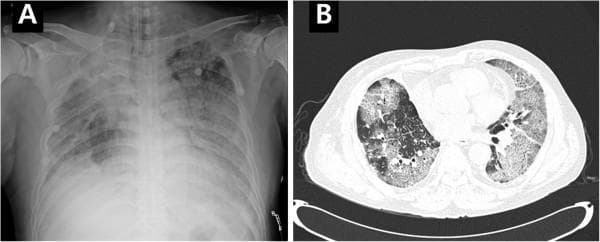 This diagnostic imaging panel consists of a chest X-ray (A) and an axial chest CT scan (B) demonstrating diffuse lung pathology. Image A is a frontal radiograph showing extensive, bilateral pulmonary infiltrations characterized by increased opacity, which appears most dense in the upper and middle lung zones. Image B is a high-resolution CT (HRCT) slice showing widespread ground-glass opacities (GGO) with superimposed interlobular septal thickening, creating a classic 'crazy-paving' pattern. These findings involve nearly all lung segments symmetrically, affecting both central and peripheral regions without significant sparing. Clinically, this combination of radiological signs is indicative of acute alveolar filling processes, such as Diffuse Alveolar Hemorrhage (DAH), pulmonary alveolar proteinosis, or severe atypical pneumonia. The imaging serves as an educational example of advanced interstitial and alveolar lung disease patterns and their appearance across different imaging modalities.