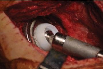 This clinical photograph provides an intraoperative in-situ view of a tripolar hip prosthesis during a revision total hip arthroplasty (THA). The image captures the surgical field of the hip joint, showing exposed soft tissue and muscle. The central focus is the novel Inovaris prosthesis assembly, which includes a metallic (cobalt-chrome) acetabular component with an visible inner locking rim. Seated within this shell is a white, high-molecular-weight polyethylene dual-mobility liner. A metallic femoral head is shown snapped into and secured within the liner. A cylindrical surgical instrument is currently engaged with the femoral head, likely for positioning or assessment of the component. The surrounding anatomy shows significant surgical disruption and raw tissue, characteristic of a direct lateral approach in a revision setting. This visual demonstrates the mechanical interface and containment mechanism of a constrained dual-mobility system designed to prevent dislocation and provide a wide range of motion.
