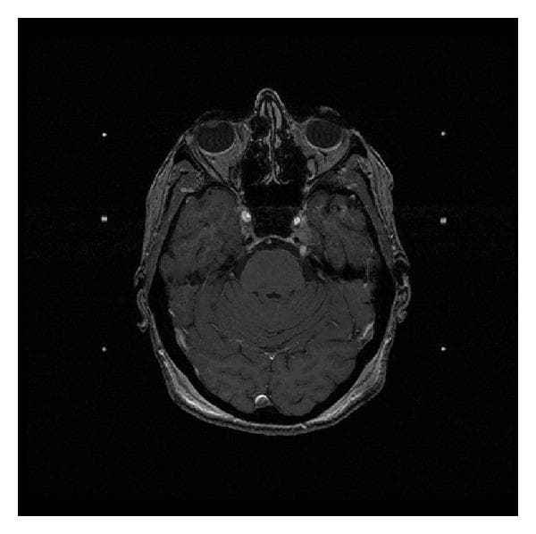 This diagnostic image is an axial T1-weighted post-gadolinium enhanced MRI of the head at the level of the skull base and brainstem. The image displays a well-circumscribed, hyperintense (brightly enhancing) mass located along the course of the left trigeminal nerve. The lesion involves the preganglionic segment and extends toward the cavernous sinus region. This enhancement pattern suggests high vascularity or a breach in the blood-nerve barrier, characteristic of a trigeminal schwannoma or similar neoplastic process. Surrounding anatomical landmarks are visible, including the pons, cerebellum, bilateral temporal lobes, orbits, and paranasal sinuses. The brain parenchyma shows normal signal intensity relative to the enhancing lesion. This image serves as a clinical example for neuro-oncology and radiology, illustrating the typical presentation of a cranial nerve sheath tumor and its anatomical relationship to the brainstem and middle cranial fossa.