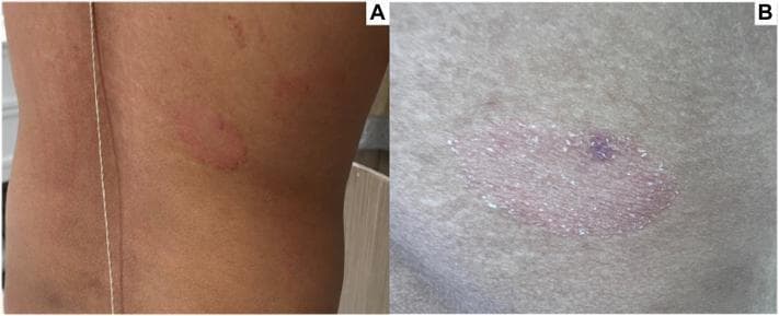 Two-panel clinical photograph displaying primary skin lesions on the mid-right back, characteristic of pityriasis rosea. Panel A shows a 2.5-cm, well-demarcated, annular red plaque on the torso, along with a secondary, smaller, ill-defined erythematous papule located superiorly. Panel B provides a high-detail close-up of the primary plaque, illustrating its morphology: it features a raised, erythematous border and a slightly depressed center with fine, surface scaling. A focal hyperpigmented macule is visible within the center of the lesion, marking the site of a prior punch biopsy. These visual findings—specifically the larger herald-style plaque with centrifugal scaling—are key clinical indicators of spongiotic dermatitis and help differentiate it from other papulosquamous disorders such as tinea corporis or nummular eczema.