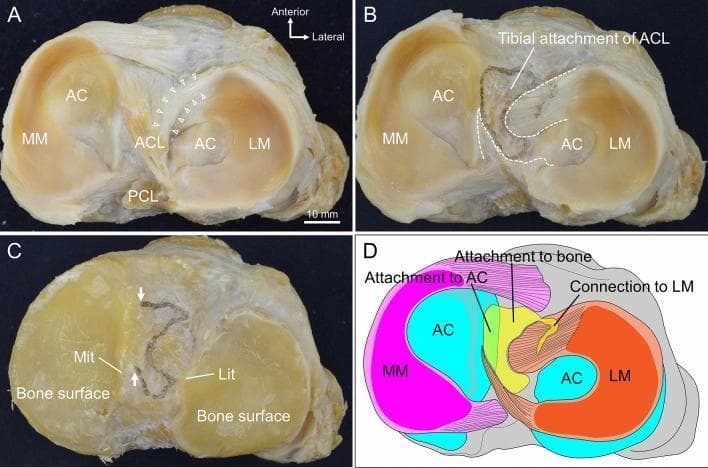 This composite educational graphic details the tibial attachment of the anterior cruciate ligament (ACL) through clinical specimen photographs and an anatomical diagram. Panel A shows a superior view of a human knee tibial plateau, illustrating the spatial relationship between the ACL, posterior cruciate ligament (PCL), medial meniscus (MM), and lateral meniscus (LM) with associated articular cartilage (AC). White arrowheads indicate fibers connecting the ACL to the LM's anterior horn. Panel B demonstrates the footprint after ACL removal, outlined with a white dashed line, showing its irregular shape abutting the AC medially and coinciding with LM horn margins. Panel C reveals the underlying bone surface after further dissection of the menisci and cartilage, highlighting the medial intercondylar tubercle (Mit) and lateral intercondylar tubercle (Lit). Panel D is a color-coded summary diagram categorizing the ACL attachment into three distinct zones: direct attachment to bone (yellow), attachment to articular cartilage (green), and connection to the lateral meniscus (orange). This material demonstrates that the ACL tibial footprint extends beyond bone to include fibrocartilaginous and meniscal tissues.
