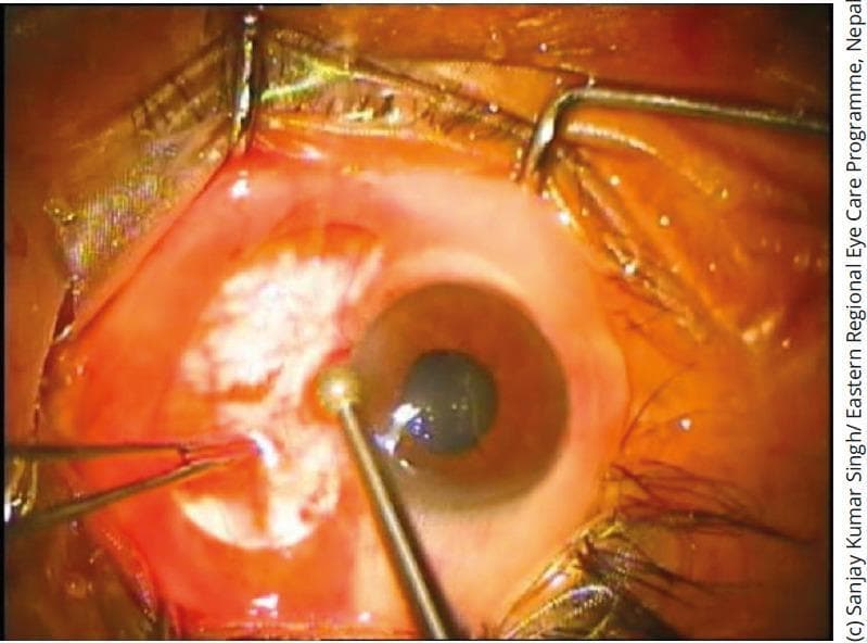 A close-up clinical photograph depicts an ophthalmic surgical procedure focusing on the cornea. The eye is maintained in an open position using a lid speculum and surgical drapes. A significant whitish, opaque lesion is visible on the peripheral corneal surface, suggestive of corneal scarring or a pterygium remnant. A diamond burr instrument, characterized by its slender metallic shaft and spherical abrasive tip, is positioned at the paracentral cornea, demonstrating the technique of corneal surface smoothening (supercial keratectomy). Forceps are visible on the lateral aspect, providing tissue stabilization. The surrounding conjunctiva appears erythematous, consistent with perioperative inflammation. This image illustrates a common step in treating corneal irregularities, recurrent erosions, or following the excision of surface lesions to improve visual acuity and reduce epithelial instability.