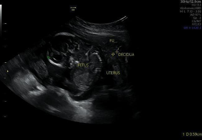 A diagnostic ultrasound image of an abdominal pregnancy, demonstrating a fetus located outside of the uterine cavity. The image captures the spatial relationship between the extrauterine fetus, the fundus (labeled 'FU'), and the uterine wall. The 'FETUS' label is placed over a region showing mixed echogenicity, where fetal structures and possibly limb buds are visible. Adjacent to the gestational sac, the 'UTERUS' is identified separately, showing a thickened endometrial lining or 'DECIDUA' (labeled with calipers). This sonographic finding is characteristic of an ectopic abdominal pregnancy, where the gestational sac is typically situated in the pouch of Douglas or attached to peritoneal surfaces rather than within the endometrial cavity. The surrounding tissues exhibit varying hypoechoic and hyperechoic patterns. The educational value of this image lies in its clear demonstration of the 'empty uterus sign' in the presence of an advanced extrauterine pregnancy, which is critical for obstetric triage and diagnosis of rare ectopic implantations.