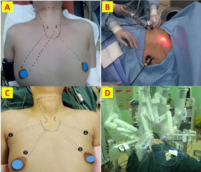 A composite of four clinical photographs demonstrating surgical approaches for remote-access thyroidectomy. Panels A and B illustrate Endoscopic Thyroidectomy via Bilateral Areola Approach (ET-BAA). Panel A shows preoperative skin markings indicating the operative tunnel from the bilateral areolar regions to the thyroid gland. Panel B displays the intraoperative setup with surgeons manually manipulating endoscopic trocars inserted via the chest wall. Panels C and D illustrate Robotic Thyroidectomy via Bilateral Axillo-Breast Approach (RT-BABA). Panel C depicts the specific four-port marking scheme: two axillary incisions (labeled 1 and 4) and two areolar incisions (labeled 2 and 3), with dashed lines outlining the dissection planes towards the neck. Panel D shows the intraoperative environment featuring a da Vinci surgical system, with multiple robotic arms draped and docked into the patient's chest and axillary ports. The images contrast the manual endoscopic technique requiring areolar access with the more complex robotic setup that utilizes four ports (axillo-breast) to facilitate a broader range of motion and 3D visualization.