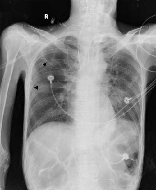 This is a frontal chest radiograph (X-ray) showing significant pulmonary findings following treatment for tuberculosis. The most prominent feature is the presence of multiple, large, thin-walled cystic lesions in the right upper lobe, highlighted by black arrowheads. These air-filled structures, identified as tuberculous pneumatoceles, measure greater than 4 cm in diameter and have replaced previous consolidation. The left lung exhibits residual reticulonodular opacities and parenchymal scarring, particularly in the upper and mid-zones. Several medical devices are visible, including ECG leads on the chest wall and what appears to be a tracheostomy tube or central line. The heart silhouette and mediastinal contours are within normal limits. The subdiaphragmatic region shows a normal bowel gas pattern. This diagnostic image illustrates the development of secondary pneumatoceles as a rare complication or sequela of pulmonary tuberculosis in an adult patient.