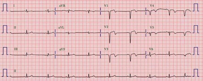 A standard 12-lead electrocardiogram (ECG) displayed on a traditional red grid background. The tracing demonstrates a normal sinus rhythm with a regular rate and consistent P-wave morphology preceding each narrow QRS complex. The axis appears normal with positive QRS deflections in leads I and aVF. There is normal R-wave progression across the precordial leads (V1-V6), characterized by an increasing R-wave amplitude and decreasing S-wave depth as the transition occurs from V1 to V5. Of clinical importance in this post-percutaneous coronary intervention (PCI) context, the ST segments are isoelectric without evidence of acute elevation or depression, and the T waves are largely upright in the lateral leads. Notably, the QT interval is within normal limits, demonstrating no signs of prolongation. This ECG serves as a baseline comparison for evaluating subsequent rhythmic stability or drug-induced repolarization abnormalities in patients treated for myocardial infarction.