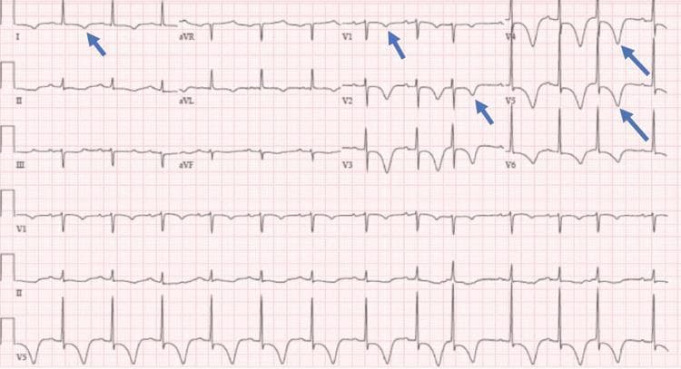 A standard 12-lead diagnostic electrocardiogram (ECG) printed on pink grid paper, demonstrating significant repolarization abnormalities. The primary visual finding is deep, symmetric T-wave inversions (TWIs) localized to the lateral (lead I) and anteroseptal to lateral precordial leads (V1 through V6). Blue arrows highlight these specific inversions in leads I, V1, V2, V4, and V5. The QRS complexes appear to be of normal duration and morphology with regular R-R intervals, suggesting a sinus rhythm. There is evidence of mild ST-segment depression accompanying the T-wave changes in the precordial leads. In contrast, the inferior leads (II, III, aVF) and augmented limb leads (aVR, aVL) show upright or flat T-wave morphology. Clinically, this pattern of widespread anterior and lateral T-wave inversion is highly significant for myocardial ischemia, such as Wellens' syndrome or non-ST elevation myocardial infarction (NSTEMI), or potentially secondary to hypertrophic cardiomyopathy or pulmonary embolism. The educational focus is on identifying patterns of ischemia and differentiating regional repolarization abnormalities.