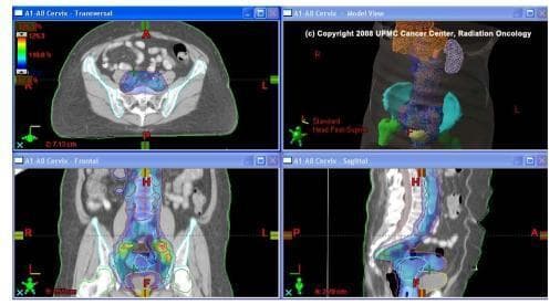 This diagnostic image display consists of four panels showing an Extended-Field Intensity-Modulated Radiation Therapy (IMRT) treatment plan for cervical cancer. The panels include axial (transversal), coronal (frontal), sagittal, and 3D model views derived from CT imaging. A color wash is overlaid on the anatomical structures to represent radiation dose distribution, where warmer colors indicate higher dosages. The plan demonstrates treatment of the primary cervical tumor and integrated boosts targeting pathologically positive pelvic lymph nodes. The radiation field extends superiorly to cover the para-aortic region, a technique known as extended-field radiation. The 3D model and multi-planar reconstructions illustrate the conformality of the dose to target volumes while showing dose-sparing for critical organs at risk (OARs), such as the kidneys and spinal cord. This visual highlights advanced radiotherapy planning used in gynecologic oncology to address metastatic nodal disease while minimizing collateral tissue damage.