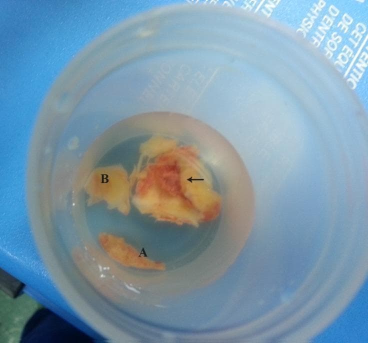 This clinical photograph displays a gross pathological specimen of resected atherosclerotic plaques from a human aorta, submerged in a clear preservative solution within a specimen container. The image shows three distinct fragments of varying size and morphology, labeled A, B, and one indicated by a horizontal arrow. Fragment A is the smallest, exhibiting a narrow, elongated, and relatively uniform appearance. Fragment B is intermediate in size with an amorphous, lumpy shape. The largest specimen, highlighted by the black horizontal arrow, demonstrates a complex, heterogeneous composition characteristic of an advanced unstable plaque. This major fragment displays multiple lobulations and distinct color variations, including yellowish-white calcified or lipid-rich areas and reddish-brown zones indicative of intraplaque hemorrhage or adherent thrombus. A central recessed area, marked by the arrow, identifies a significant ulceration on the plaque surface. These findings illustrate the macroscopic features of complex aortic atherosclerosis, which can serve as a source for systemic embolic events.