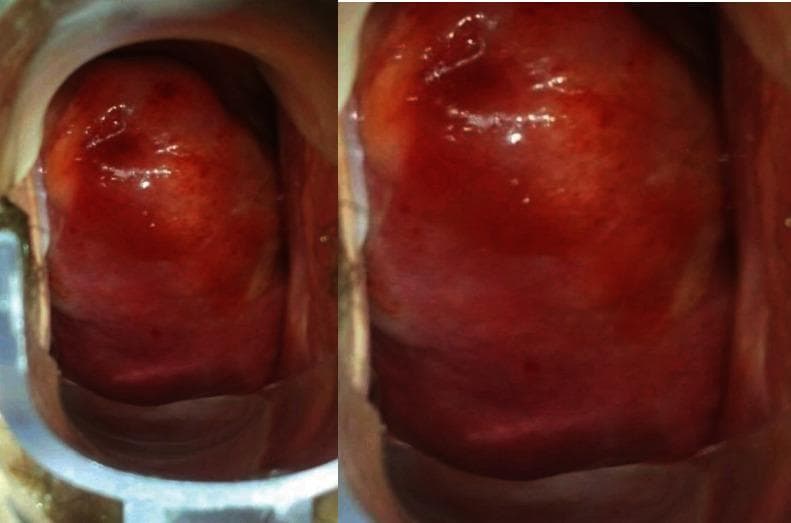 This clinical photograph displays a colposcopic view of the cervix. The cervix appears significantly enlarged and occupies the majority of the vaginal vault, consistent with a bulky or 'stony' clinical presentation. The surface of the cervix and the adjacent posterior vaginal fornix exhibit a distinct 'discolored area' characterized by a dark red, erythematous appearance. Numerous fine, dark red punctations are visible across the surface, representing abnormal vascular patterns. While the surface texture remains relatively smooth without overt epithelial laceration or ulceration, the atypical vascularity and discoloration are prominent. The squamocolumnar junction and cervical os are not clearly demarcated due to the presence of the lesion. This image is used to demonstrate clinical findings in the gynecologic evaluation of abnormal cervical masses, where differential diagnoses include cervical fibroids or rarer entities such as extramedullary leukemic infiltration of the female genital tract.