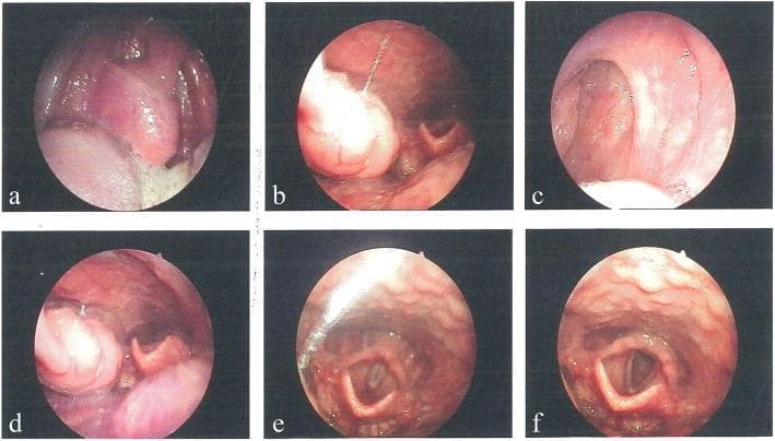 This composite of six clinical endoscopic images (a-f) captures various views of the upper airway and oropharynx obtained via laryngoscopy. Panels (a) through (d) demonstrate significant tonsillar hypertrophy, characterized by enlarged palatine tonsils that narrow the oropharyngeal space. The right tonsil displays grade 3 hypertrophy, while the left tonsil is grade 2. The images also reveal an elongated uvula and notable lymphoid hyperplasia along the posterior pharyngeal wall, appearing as a cobblestone-like, irregular mucosal texture. Panels (e) and (f) provide a clear view of the laryngeal inlet, showing the epiglottis, arytenoid cartilages, and the true vocal cords. The vocal cords appear as symmetrical, pearly-white bands in an abducted position, defining the glottic opening. These clinical findings are consistent with chronic tonsillitis and upper airway obstruction due to hypertrophic lymphoid tissue. The images serve as an educational tool for identifying grades of tonsillar enlargement and assessing pharyngeal lymphoid architecture.