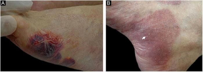 Clinical photograph of dermatological manifestations of Bullous Pemphigoid (BP) on the lower extremities, divided into two panels. Image A displays the acute phase, showing a large, tense hemorrhagic bulla with a characteristic dark purple-red hue on the foot. The bulla is situated atop an ill-defined erythematous plaque, indicating underlying cutaneous inflammation. Image B demonstrates a later stage of disease progression on the skin. It depicts large, confluent erythematous and violaceous plaques with evidence of cicatricial (scarring) changes from prior blistering. Multiple small, white, firm papules known as milia are visible; one milium is specifically indicated by a white arrow. The presence of milia over healed or scarring areas is a recognized clinical feature in certain subsets of Bullous Pemphigoid. This comparison illustrates the transition from active hemorrhagic vesicobullous lesions to chronic cicatricial stages with secondary milium formation.