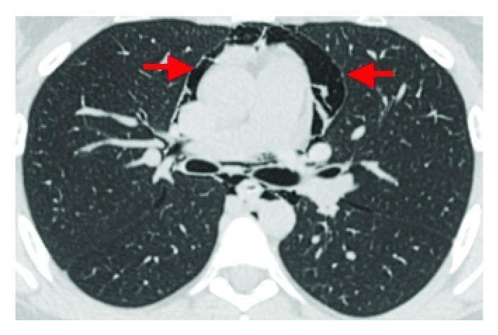 This diagnostic image is an axial contrast-enhanced CT scan of the chest presented in a lung window. The primary pathology demonstrated is pneumomediastinum, indicated by prominent collections of extraluminal air (hypodense areas) within the mediastinal space, specifically surrounding the heart and great vessels (indicated by red arrows). The air tracks along the pericardiac spaces and fascial planes. Additionally, there are signs of subcutaneous emphysema within the chest wall tissues. The lung parenchyma bilaterally appears largely unremarkable with normal bronchovascular markings and no evidence of significant consolidation, pulmonary edema, or pneumothorax. This image serves as a clinical example of Hamman's syndrome or spontaneous pneumomediastinum, often seen following intense physical exertion such as labor. The absence of contrast extravasation helps rule out esophageal rupture (Boerhaave syndrome) in this clinical context.