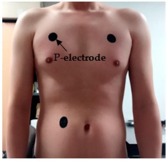 A clinical photograph of a human torso demonstrating the application and placement of carbon-paste patch electrodes (P-electrodes) for electrocardiogram (ECG) monitoring. The image shows three circular, dark-colored (carbon-based) electrodes adhered to the skin. Two electrodes are positioned on the upper chest bilaterally, located superior and slightly lateral to the nipples in the pectoral region to serve as positive and negative leads. A third electrode, acting as a ground, is placed on the left side of the abdomen, lateral to the umbilicus and inferior to the ribcage. The labels identify these as 'P-electrodes,' which are flexible, conformal wearable sensors made from conductive paste. The visual emphasizes the specific anatomical landmarks used for 3-lead ECG measurement setup. This content is relevant for biomedical engineering and cardiology education, focusing on wearable health technology, signal acquisition, and electrode-skin interface stability.