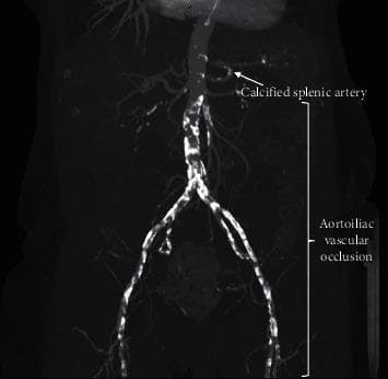 This diagnostic image is a Computed Tomography (CT) angiography reconstruction with maximum intensity projection (MIP) focusing on the abdominal and pelvic vasculature. The image demonstrates severe aortoiliac occlusive disease (AIOD), also known as Leriche syndrome. Key visual findings include extensive atherosclerotic plaque and mural calcification along the distal abdominal aorta, extending through the aortic bifurcation into the common and external iliac arteries bilaterally. The contrast opacification is significantly diminished or absent in these segments, indicating high-grade stenosis or complete vascular occlusion. Additionally, an arrow highlights a tortuous, calcified splenic artery in the upper left quadrant. The image serves as a clinical illustration of unsuitable pelvic vasculature for traditional renal transplantation, necessitating alternative surgical strategies such as orthotopic kidney transplantation (OKT) or autotransplantation. Educational focus is on vascular anatomy, atherosclerotic progression, and preoperative surgical planning for transplant recipients with complex vascular comorbidities.