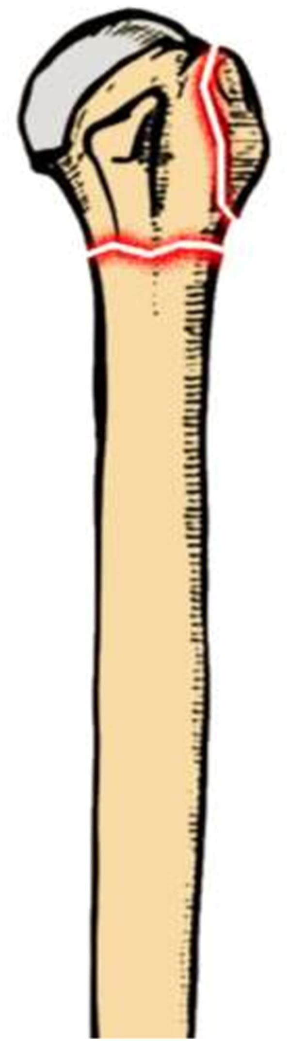 Anatomical illustration of a human proximal humerus depicting a displaced two-part fracture pattern. The diagram shows the humeral head, anatomical neck, and greater tuberosity regions. Red highlighted lines indicate fracture sites: a primary transverse fracture line across the surgical neck of the humerus and a secondary vertical fracture line involving the greater tuberosity and superior humeral head. The bone is rendered in a tan color with a gray articular surface for the glenoid fossa. This visual aid is designed for orthopedic education, specifically demonstrating the common components of Neer classification for proximal humeral fractures before surgical reduction and internal fixation.