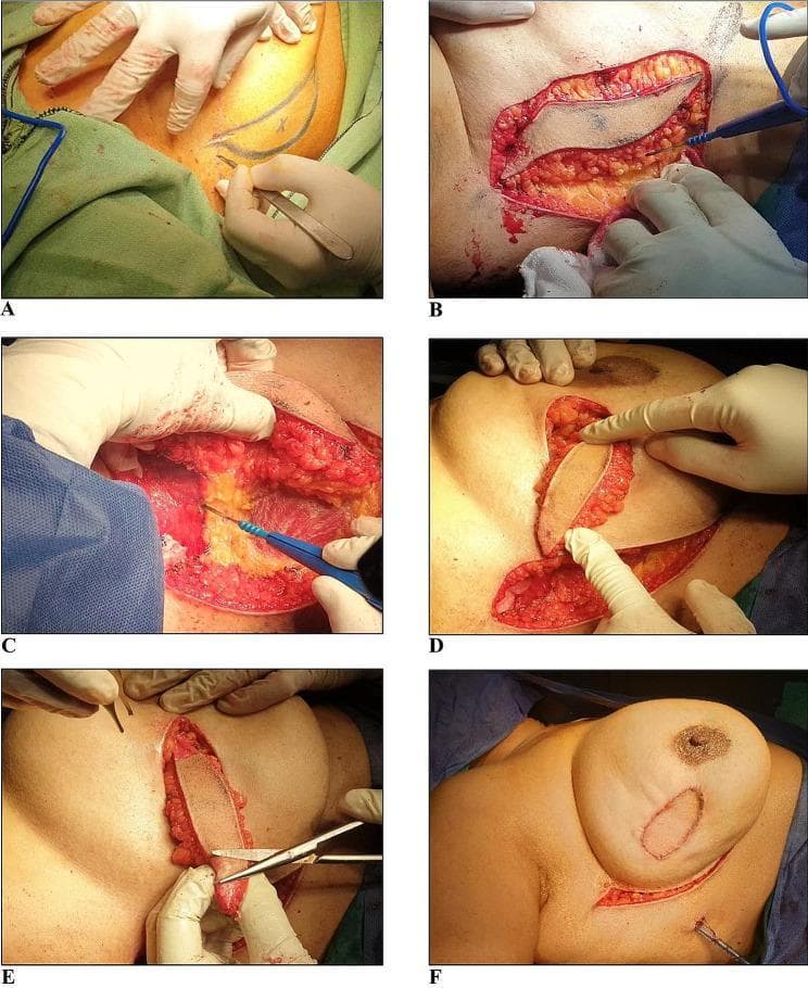 A series of six clinical photographs (A-F) documenting the surgical technique of a lateral intercostal artery perforator (LICAP) flap for oncoplastic breast reconstruction. (A) Pre-incisional view shows marked sickle-shaped margins on the lateral chest wall. (B) Initial incision and dissection of the skin flap. (C) Intraoperative close-up demonstrating the mobilization of the adipocutaneous flap while preserving the vascular perforator within its fatty mesentery. (D) The harvested flap is tunneled subcutaneously and flipped medially to reach the lumpectomy defect in the breast. (E) Preparation of the flap through selective de-epithelialization of the skin edges to ensure a proper fit within the recipient site. (F) Final postoperative view showing the flap fixed within the lumpectomy defect with sutures and the direct primary closure of the lateral donor site. This sequence illustrates a volume-replacement technique used to maintain breast contour and symmetry following breast-conserving surgery (BCS).