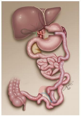 This medical anatomical diagram illustrates a surgical modification of a biliopancreatic diversion (BPD), specifically detailing the elongation of the common loop to treat malnutrition complications. The upper portion of the diagram shows the liver, gallbladder, and a preserved gastric reservoir (stomach). The surgical rearrangement involves the small intestine, highlighting three distinct segments: the biliopancreatic loop (carrying digestive juices), the alimentary (food) loop, and the common loop (where digestion and absorption occur). A blue arrow and shaded area indicate the critical modification: the previous jejunoileal anastomosis has been sectioned, and the alimentary loop is being re-anastomosed further upstream, 1.5 meters from the biliopancreatic loop. This intervention effectively lengthens the common loop, increasing the intestinal surface area available for nutrient absorption. The diagram also depicts the pancreas and the distal large intestine for anatomical context. This visual serves as an educational tool for bariatric surgeons and advanced medical students to understand revisional procedures for managing malabsorption following restrictive-distractive bariatric surgery.