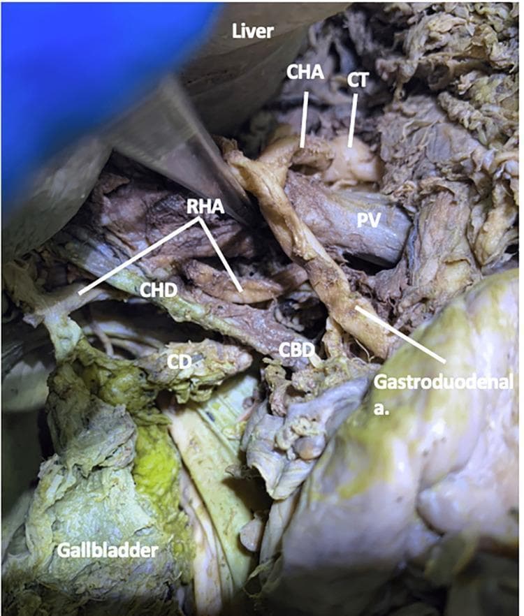 This clinical photograph from a gross anatomical dissection displays the hepatobiliary vasculature and biliary tree within the cystic triangle (Calot's triangle). The image illustrates a variation of the right hepatic artery (RHA), which is shown coursing between the portal vein (PV) and the common bile duct (CBD). Labeled structures include the liver (superiorly), gallbladder (inferiorly), cystic duct (CD), common hepatic duct (CHD), and common bile duct (CBD). The arterial supply is represented by the celiac trunk (CT), common hepatic artery (CHA), and the gastroduodenal artery. The educational focus of this image is to demonstrate the complex spatial relationships and anatomical variations of the hepatic artery in relation to the portal venous system and the extrahepatic biliary ducts, which is critical for surgical procedures like cholecystectomy. The RHA is seen moving laterally and anteriorly relative to the PV as it enters the cystic triangle to supply the gallbladder and right liver lobe.
