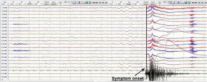This diagnostic image shows a continuous 22-channel scalp electroencephalogram (EEG) recording from a patient with anti-LGI1 encephalitis during a faciobrachial dystonic seizure (FBDS). The tracing is divided into two distinct phases by a vertical black line marked 'Symptom onset'. Prior to the marker, the EEG demonstrates a relatively stable, low-to-moderate amplitude rhythmic background without clear epileptiform discharges or focal slowing. Following the 'Symptom onset' marker, there is a notable absence of typical ictal rhythmic evolution; instead, the tracing is dominated by prominent high-amplitude, irregular movement artifacts. These artifacts are most severe in the lower channels (specifically channels 18–22), likely representing muscle activity (EMG) and movement related to the clinical manifestation of the seizure, such as twitching of the arm or face. The image serves as a clinical example of how FBDS often presents with movement-induced artifacts on EEG rather than clear electrographic ictal patterns, highlighting the diagnostic challenges in autoimmune epilepsy.