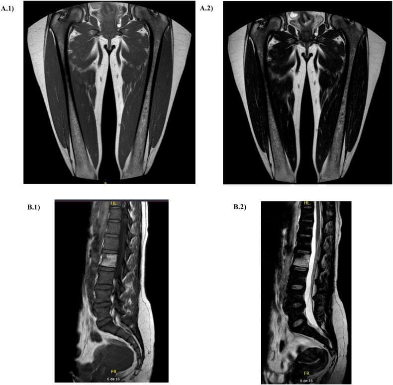 This figure presents a series of Magnetic Resonance Imaging (MRI) scans used for the assessment of bone marrow involvement in Gaucher disease (GD). Panels A.1 and A.2 display coronal views of the bilateral femurs. Panel A.1 is a T1-weighted image showing characteristic low signal intensity (darkening) within the femoral shafts, indicating displacement of normal fatty marrow by Gaucher cells. Panel A.2 is a T2-weighted sequence of the same region, highlighting marrow infiltration patterns. Panels B.1 and B.2 show sagittal views of the lumbar spine and sacrum. Panel B.1 (T1-weighted) reveals diffuse low signal intensity throughout the vertebral bodies, consistent with Gaucher cell infiltration. Panel B.2 (T2-weighted) shows the spinal canal with hyperintense cerebrospinal fluid (CSF) providing contrast against the vertebral bodies. These images are used to calculate the Bone Marrow Burden (BMB) score, a clinical tool for quantifying skeletal involvement and monitoring treatment response in patients with lysosomal storage disorders. The scans demonstrate typical skeletal manifestations including infiltration of the axial and appendicular skeleton without evidence of acute bone crisis or significant avascular necrosis in this specific view.