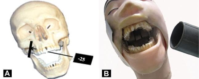 This composite educational image illustrates dental radiographic positioning and angulation using a head phantom and skull model. Image A features a human skull model demonstrating the vertical angulation for maxillary posterior imaging, showing the central X-ray beam directed at a negative 25-degree angle from the horizontal plane, originating from the zygomatic region toward the upper molars. Image B shows a clinical simulation with a dental phantom head in a wide-open mouth position, tilted approximately 10 degrees toward the side of interest. A cylindrical X-ray collimator (cone) is positioned extraorally, demonstrating the alignment required for specialized extraoral dental projections. The focus of the material is to teach dental students and clinicians the precise anatomical landmarks, such as the canthomeatal line and Frankfort plane, necessary for standardized radiographic capture of maxillary and mandibular molars.