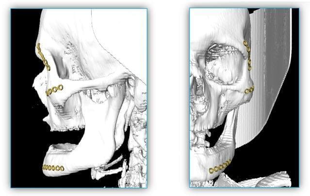 This diagnostic image displays a three-dimensional computer-aided design (CAD) reconstruction of a human skull, demonstrating the application of cranio-maxillofacial osteosynthesis materials. The figure is divided into two perspectives: a sagittal view on the left and a coronal view on the right. Both views highlight the placement of three distinct titanium miniplates (depicted in gold) commonly used in the treatment of mid-facial and mandibular trauma. The first miniplate is positioned on the zygomatic bone near the frontozygomatic suture. The second is situated on the maxilla, in the region of the infraorbital rim and zygomaticomaxillary buttress. The third miniplate is fixed to the anterior body of the mandible. Each plate features a series of circular 'ring sections' designed for screw fixation. Anatomical landmarks such as the zygomatic arch, infraorbital foramen, and the ramus and body of the mandible are clearly visualized in the white, translucent bone rendering. The image illustrates the clinical application of bone fracture fixation systems in complex facial trauma scenarios.