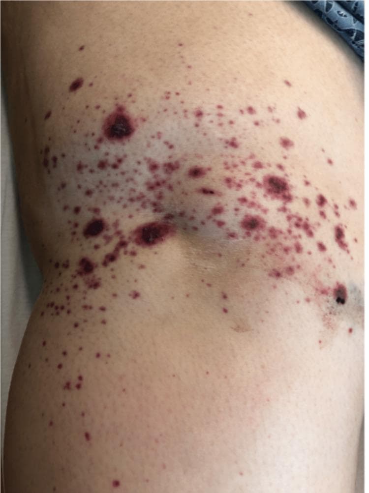 This clinical photograph shows a close-up view of a cutaneous eruption on a human extremity, specifically identified as a purpuric rash. The primary lesions consist of non-blanching, petechiae (pinpoint spots) and larger ecchymoses (purple-red blotches) that range in size from approximately 1 mm to several centimeters. The morphology includes flat macules and slightly raised, palpable papules, characteristic of palpable purpura. The lesions exhibit a range of colors from bright red to dark violaceous and purplish-black, indicating areas of acute hemorrhage and more significant dermal blood accumulation. The distribution is diffuse and irregular across the limb, with several areas showing higher density or clustering of lesions. There is no evidence of active ulceration, crusting, or diffuse erythema in the surrounding skin. This visual presentation is highly suggestive of small-vessel vasculitis, such as IgA vasculitis (Henoch-Schönlein purpura), which often presents with this type of leukocytoclastic vasculitis (LCV) pattern on the lower or upper extremities.