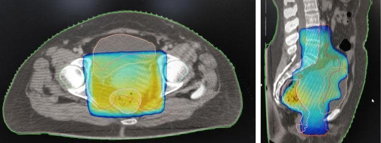 This diagnostic image displays a three-dimensional conformal radiotherapy (3DCRT) treatment plan for a patient with cervical cancer, shown in axial (left) and sagittal (right) CT sections. The images illustrate the distribution of external beam radiotherapy (EBRT) using a color wash overlay that represents the 95% isodose coverage. The color wash, transitioning from blue at the periphery to green and yellow at the center, is concentrated over the pelvic region, specifically targeting the clinical target volume (CTV) encompassing the uterus, cervix, and upper vagina. Several anatomical contours are visible: a white outline defining the target volume and a light orange outline tracing organs at risk, such as the bladder. In the axial view, the radiation dose maintains a rectangular-like field typical of multi-field conformal techniques, while the sagittal view shows the longitudinal coverage from the lower uterus down to the vaginal vault. This visual serves as an educational example of radiation oncology planning, demonstrating dose distribution and target localization in the management of FIGO stage IIB cervical carcinoma.