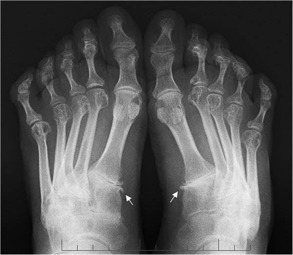 This anteroposterior (AP) radiograph of both feet demonstrates chronic inflammatory and degenerative changes characteristic of rheumatoid arthritis. The imaging shows significant forefoot involvement, including bilateral metatarsophalangeal (MTP) joint instability and subluxation of the first MTP joints. Key findings include prominent osteophyte formation at the medial aspects of the bilateral first cuneometatarsal (CM) joints, indicated by white arrows, which signifies joint hypermobility and secondary osteoarthritis. There is evidence of generalized periarticular osteopenia and joint space narrowing across the tarsal and MTP regions. The first intermetatarsal angle is increased bilateral, consistent with hallux valgus deformity development secondary to connective tissue laxity. The lesser toes exhibit deformities, including lateral deviation and clawing, typical of rheumatoid forefoot progression. This diagnostic image serves as a clinical example of midfoot and forefoot structural changes in systemic inflammatory arthritis, highlighting the relationship between joint instability and osteophyte development at the first ray.