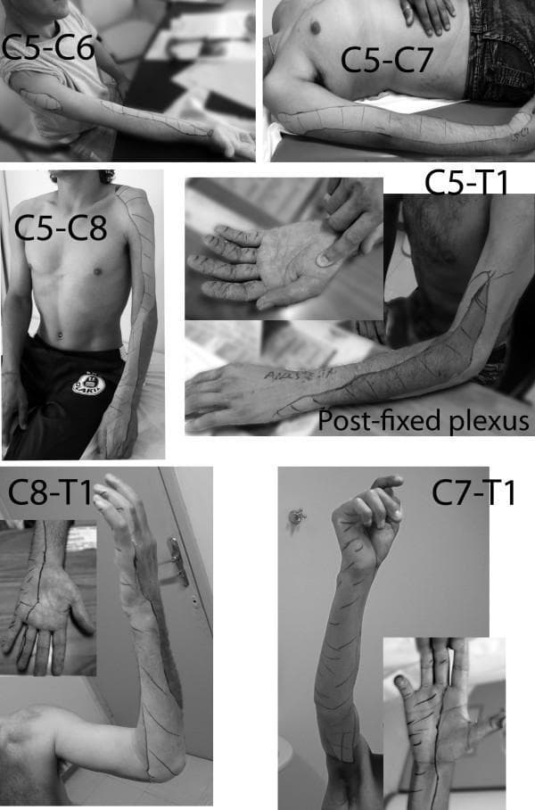 A compilation of clinical photographs depicting sensory mapping of the upper limb in different types of brachial plexus palsy. The images use skin marking to delineate zones of lost protective sensation (determined by Semmes-Weinstein monofilament testing). The series illustrates progression of sensory loss across several injury levels: C5-C6 (lateral forearm), C5-C7 (lateral arm and forearm), C5-C8 (extended lateral involvement and dorsal hand anesthesia), and C5-T1 with post-fixed plexus (near-total limb involvement with small medial zones of preservation). Lower plexus injuries are also shown, including C8-T1 (medial forearm and ulnar hand involvement) and C7-T1 (extending to the inner arm and middle finger). Key educational concepts include the correlation between brachial plexus root involvement and specific cutaneous dermatomal deficits, as well as the variability introduced by anatomical variations like post-fixation. The imagery serves as a diagnostic guide for identifying the level of nerve root avulsion or injury based on distal sensory presentation.
