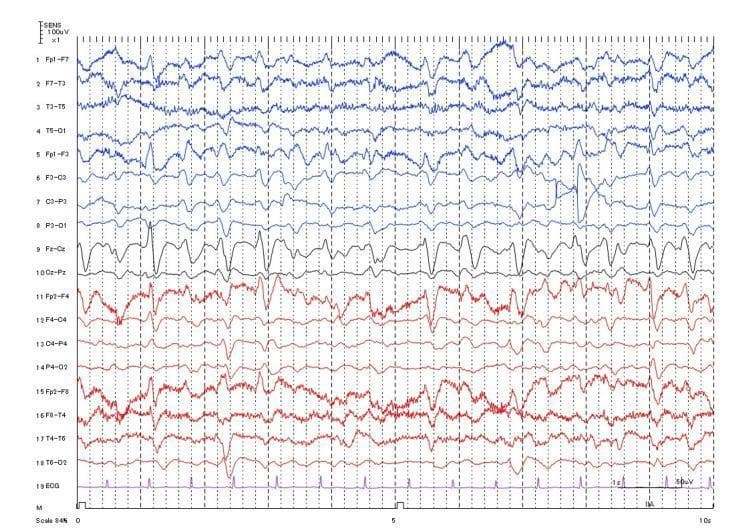 This diagnostic image is an electroencephalogram (EEG) recording with a simultaneous single-lead electrocardiogram (ECG) trace at the bottom (Channel 19). The EEG montage displays 18 channels of cortical activity, including frontal, temporal, parietal, and occipital regions (e.g., Fp1-F7, Fp2-F4, T6-O2). The tracing demonstrates generalized cerebral slowing characterized by high-amplitude, low-frequency delta and theta waveforms ranging between 150 to 200 μV. Prominent triphasic waves are visible across several channels, exhibiting a characteristic morphology with an initial sharp negative component followed by a larger positive deflection and a subsequent slow negative wave. These waveforms show bilateral synchrony and a discernible anterior-to-posterior time lag. The ECG channel shows a regular sinus rhythm with distinct QRS complexes, which is used for artifact identification. Such EEG patterns, particularly the generalized slowing and triphasic waves, are clinically significant markers of metabolic or toxic encephalopathy, such as antibiotic-associated encephalopathy (AAE).