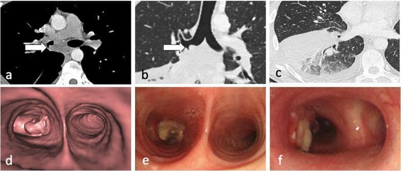 This composite figure illustrates a case of tracheobronchial tuberculosis involving lymph node invasion into the airway. (a) Axial CT in a mediastinal window demonstrates a 29 mm subcarinal lymph node (arrow) exhibiting central low attenuation, suggestive of necrosis. (b) Coronal CT in a lung window shows the node invading the wall of the right main bronchus. (c) Axial CT in a lung window reveals heterogeneous consolidation in the right lower lobe and a small right pleural effusion, likely representing post-obstructive changes. (d) CT virtual bronchoscopy provides a 3D reconstruction of the subcarinal mass protruding into the right main bronchial lumen. (e) Fiberoptic bronchoscopy confirms a yellowish/tan-colored, irregular necrotic nodule partially obstructing the right main bronchus. (f) Post-procedural bronchoscopy shows a patent airway lumen following successful cryoprobe removal of the necrotic lymph node tissue. The images collectively demonstrate the complications of tuberculous lymphadenopathy, including bronchial perforation and distal lung consolidation.