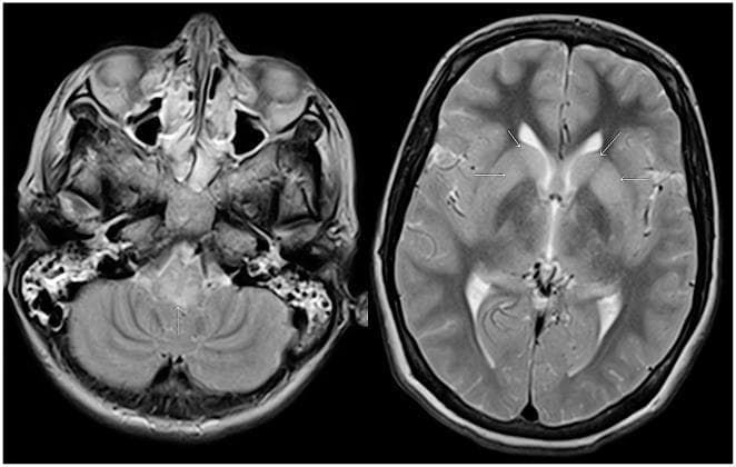 Two axial T2-weighted MRI scans of the brain demonstrating neuroimaging findings in a patient with Duvenhage virus (rabies) infection. The left image shows a cross-section of the posterior fossa, featuring the medulla oblongata, pons, and cerebellum. A distinct area of hyperintensity (increased signal) is indicated by an arrow in the posterior aspect of the medulla oblongata. The right image shows a higher axial section through the cerebral hemispheres, including the lateral ventricles and deep gray matter. Multiple white arrows highlight diffuse, bilateral areas of increased signal intensity within the basal ganglia. The ventricles appear fluid-filled and dark, while the surrounding brain parenchyma shows heterogeneous signals. These findings are consistent with viral encephalitis, specifically highlighting the predilection of rabies viruses for brainstem and deep gray matter structures. These diagnostic images illustrate the progression of infectious encephalitis and provide clinical evidence of brainstem and subcortical involvement.