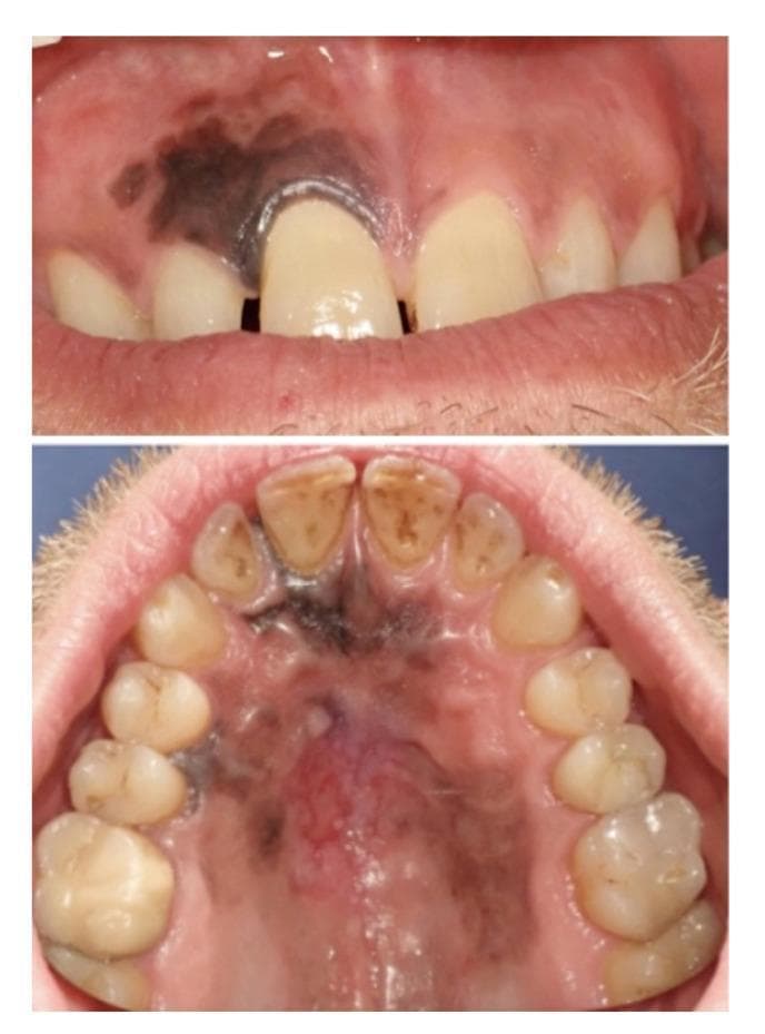 This clinical intraoral photograph set displays pigmented lesions in the maxillary gingiva and hard palate of a 45-year-old male. The upper image shows a large, irregularly shaped, dark brown-to-black macule on the anterior maxillary gingiva, primarily affecting the right central and lateral incisor regions. The pigmentation extends to the gingival margin and interdentally. The lower image provides a palatal view, revealing a more extensive, heterogeneous pigmented lesion covering a significant portion of the hard palate. This lesion exhibits variegated coloring, including deep black, brown, and bluish-grey tones, with ill-defined, asymmetric borders. A central area of erythematous change suggests focal ulceration. These clinical features are highly suspicious for mucosal melanoma. This content is intended for dental and oncology students to illustrate the clinical presentation of oral malignant melanocytic lesions, highlighting the importance of evaluating lesion color, border irregularity, and anatomical extent across the palatal and gingival mucosa.
