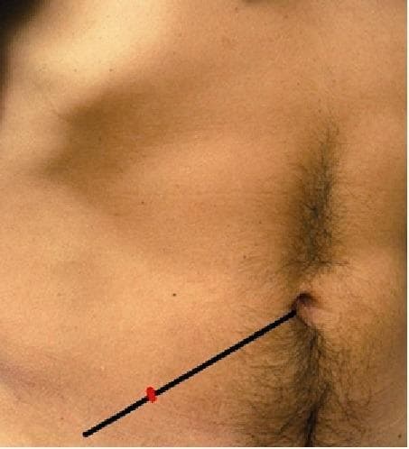 A clinical photograph of the human lower abdomen illustrating surface anatomy landmarks used in surgical evaluation. A black line represents the spino-umbilical line, extending from the umbilicus to the right anterior superior iliac spine (ASIS). A red mark is placed on this line at the junction of the lateral one-third and the medial two-thirds, identifying McBurney's point. This landmark is clinically significant as it traditionally corresponds to the base of the vermiform appendix and serves as a primary site for tenderness assessment in cases of suspected acute appendicitis. The photograph provides a clear visual guide for physical examination techniques in emergency medicine and general surgery.