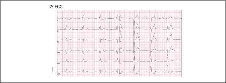 A 12-lead diagnostic electrocardiogram (ECG) demonstrating a persistent left bundle branch block (LBBB) accompanied by a first-degree atrioventricular (AV) block. The ECG shows a regular rhythm with a prolonged PR interval measured at 320ms, consistent with first-degree AV delay. Key features of LBBB are present, including wide, prolonged QRS complexes throughout the tracing. Specifically, the precordial leads V1 and V2 exhibit deep, predominantly negative S waves, while the lateral leads V5 and V6 demonstrate tall, predominantly positive R waves with characteristic notching. This combination of conduction disturbances in an elderly patient suggests significant His-Purkinje system disease or structural cardiac changes such as fibrosis. The image serves as an educational example of intraventricular conduction delay and fixed AV nodal delay within the context of complex arrhythmias.