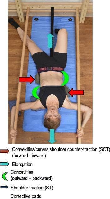 This clinical photograph illustrates a patient performing a Schroth method supine exercise for the conservative treatment of adolescent idiopathic scoliosis, specifically targeting a major lumbar curve. The patient is positioned on a blue mat, utilizing wall bars for bilateral shoulder traction. One leg is flexed while the other is extended and stabilized with a belt for pelvic counter-traction. The image is overlaid with instructional icons representing Physiotherapeutic Scoliosis-Specific Exercises (PSSE) principles: turquoise arrows indicate cranial and caudal axial elongation; red arrows signify counter-traction forces directed at convexities to shift the spine inward toward the midline; and green half-moons denote areas of concavity expansion to facilitate rotational angular breathing. Small pads are strategically placed to support corrective alignment. This visual serves as a pedagogical tool for demonstrating 3D postural self-correction, muscle activation around spinal curves, and the use of external supports to prevent postural collapse in scoliosis rehabilitation.