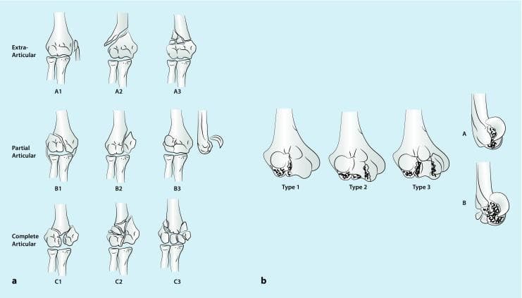 Educational orthopedic diagrams illustrating classification systems for distal humerus fractures. Section (a) displays the AO classification system in three rows: Extra-articular (Type A), showing fractures proximal to the joint line; Partial Articular (Type B), showing fractures extending into the joint but leaving part of the articular surface attached to the shaft; and Complete Articular (Type C), showing complete dissociation of the articular surface from the shaft. Section (b) illustrates the Dubberley classification for coronal shear fractures (AO Type B3). Frontal views categorize fractures into Type 1 (capitellum), Type 2 (continuous capitellum and trochlea), and Type 3 (separate capitellum and trochlea fragments). Lateral profiles differentiate between Type A (absence of dorsal comminution) and Type B (presence of posterior/dorsal comminution). These diagrams serve as clinical guides for orthopedic surgical planning, helping determine the necessity of headless compression screws or locking plate osteosynthesis based on fracture morphology and joint involvement.