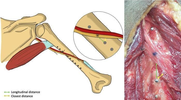 This composite educational graphic includes an anatomical illustration and a corresponding cadaveric clinical photograph focusing on the posterior view of a right humerus during a surgical procedure. The illustration on the left depicts the humeral shaft, shoulder girdle, and the course of the radial nerve (yellow) and profunda brachii artery (red) as they spiral across the posterior aspect of the bone. Several metallic screws are shown penetrating the humeral shaft from an anterolateral plate fixation. A magnified inset highlights the relationship between the screw tips and the neurovascular structures. The clinical photograph on the right shows a deep dissection of the upper arm, revealing the reddish-striated musculature, the humeral bone, and the exposed radial nerve. Both the diagram and the photograph utilize a color-coded measurement system: a green double-headed arrow indicates the longitudinal distance from the screw hole to the neurovascular structure, while a yellow double-headed arrow indicates the closest perpendicular distance. The content demonstrates the risk of iatrogenic neurovascular injury during humeral plating, specifically assessing the proximity of screw placement to vital structures.
