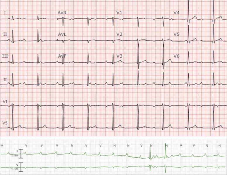 This diagnostic image contains a standard 12-lead electrocardiogram (ECG) and a continuous rhythm strip demonstrating complete (third-degree) atrioventricular (AV) block. The 12-lead ECG at the top displays narrow QRS complexes with a relatively slow ventricular rate. A critical finding is AV dissociation, where P-waves and QRS complexes occur independently of each other, indicating no electrical communication between the atria and ventricles. The rhythm strip at the bottom provides a detailed view of this pathology, showing regular sinus P-waves (atrial activity) that are frequently non-conducted, resulting in significant ventricular pauses and an irregular ventricular rhythm. The preservation of narrow QRS morphology suggests a proximal escape pacemaker, likely located in the AV junction. This visual material is a classic representation of high-grade conduction system disease, used in cardiology and emergency medicine education to illustrate the criteria for complete heart block and the identification of non-conducted P-waves.