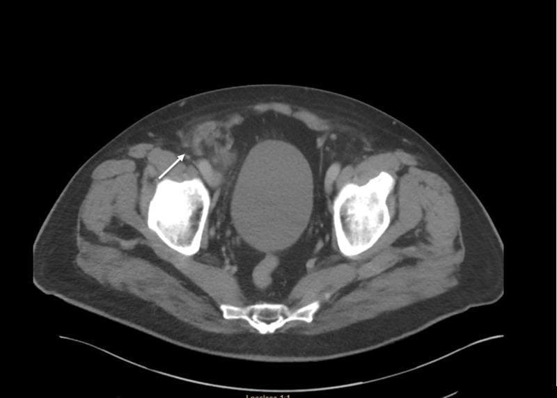 This diagnostic image is an axial computed tomography (CT) scan of the lower abdomen and pelvis. It reveals the bony anatomy of the pelvis, including the bilateral iliac bones, sacrum, and right femoral head, characterized by high-density (bright white) attenuation. In the midline, a fluid-filled urinary bladder is visible. The primary pathological finding, indicated by a white arrow, is a heterogeneous soft tissue mass in the right groin region, consistent with an incarcerated right femoral hernia. The hernia sac contains an inflamed appendix (De Garengeot hernia), evidenced by a tubular structure with surrounding fat stranding and increased attenuation, indicating localized inflammation. The mass is positioned medial to the femoral vessels and posterior to the inguinal ligament, typical for femoral hernia anatomy. This image illustrates a rare clinical presentation where the vermiform appendix becomes trapped within a femoral hernia sac, leading to appendicitis within the groin bulge.