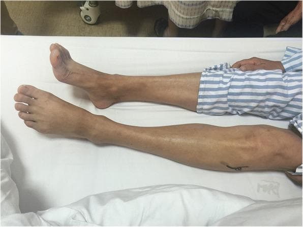 This clinical photograph displays the lower legs of a patient in a supine position, highlighting a unilateral foot drop of the left foot. The right foot maintains a neutral, upright position, whereas the left foot exhibits noticeable plantar flexion and an inability to dorsiflex. Furthermore, significant ecchymoses (bruising) are visible on the lateral aspect of the left knee and proximal calf, localized near the fibular head. These combined clinical signs—acute foot drop and localized trauma markers—are indicative of common peroneal (fibular) nerve palsy, which may result from external compression, trauma, or space-occupying lesions such as an intraneural ganglion cyst. This image serves as an educational example of the neurological and dermatological manifestations associated with peripheral nerve injury in the lower limb.