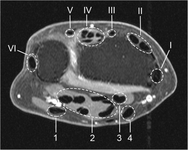 This diagnostic image is an axial T1-weighted, post-gadolinium, fat-saturated MRI of the human wrist, specifically used for evaluating tenosynovitis. The image demonstrates the cross-sectional anatomy of the flexor and extensor tendon regions, which are outlined with dashed white circles and labeled for educational indexing. The six extensor compartments are indicated by Roman numerals (I-VI): I (abductor pollicis longus and extensor pollicis brevis), II (extensor carpi radialis longus/brevis), III (extensor pollicis longus), IV (extensor digitorum communis and indicis proprius), V (extensor digiti quinti), and VI (extensor carpi ulnaris). The four flexor regions are marked with Arabic numerals (1-4): 1 (flexor carpi ulnaris), 2 (ulnar bursa containing flexor digitorum tendons), 3 (flexor pollicis longus in the radial bursa), and 4 (flexor carpi radialis). The modality highlights synovial enhancement, where high signal intensity in these regions indicates inflammation (tenosynovitis). This visual is a primary reference for musculoskeletal radiology and rheumatology, illustrating standard anatomical landmarks for clinical scoring of inflammatory wrist conditions.