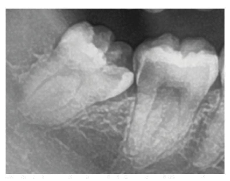 A close-up dental radiograph (periapical x-ray) demonstrating a partially erupted mandibular third molar in a mesioangular orientation. According to Winter's classification, the tooth is tilted mesially toward the adjacent second molar. Applying the Pell and Gregory classification, the tooth is in Position A, with its highest occlusal point at or above the occlusal plane of the second molar. Pathologically, the image reveals significant radiolucent areas indicative of dental caries on both teeth: distal caries on the crown of the second molar and mesial caries on the third molar. This visual represents a common clinical complication of impacted or partially erupted third molars, where food impaction and difficulty in hygiene lead to decay in both the wisdom tooth and the adjacent functional dentition. The image serves as an educational tool for oral surgery and restorative dentistry regarding impaction assessment and its secondary pathological effects.