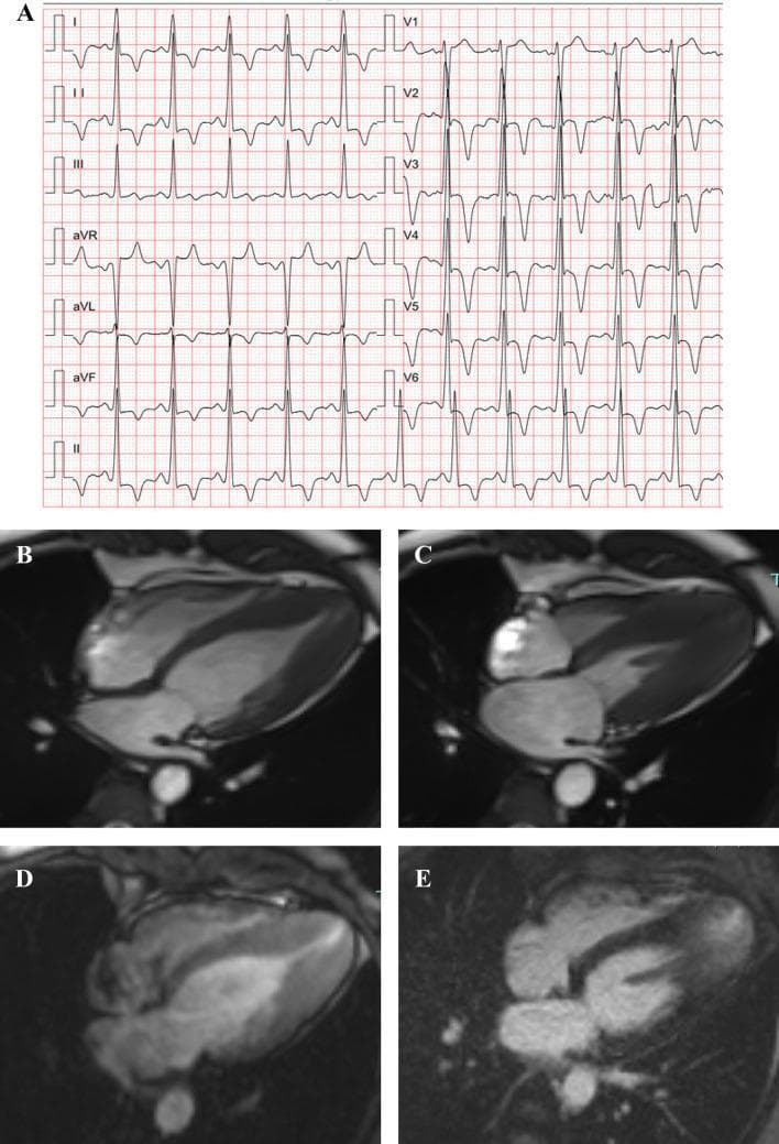 This composite educational graphic illustrates the diagnostic features of Apical Hypertrophic Cardiomyopathy (ApHCM) through electrocardiography (ECG) and Cardiac Magnetic Resonance (CMR) imaging. Panel A shows a 12-lead ECG characterized by high-voltage QRS complexes in the precordial leads, meeting voltage criteria for left ventricular hypertrophy, and striking, giant negative T-wave inversions (deeply symmetric), particularly in leads V2 through V6. Panels B through E present CMR four-chamber views demonstrating the structural manifestations of the disease. Diastolic imaging (B) shows relative thickening of the left ventricular apex (13.5 mm). Systolic imaging (C) depicts apical cavity obliteration, where the hypertrophied myocardium eliminates the distal ventricular space. Panel D identifies a small apical aneurysm, a known complication of localized hypertrophy. Panel E displays Late Gadolinium Enhancement (LGE) at the apex, indicating localized myocardial fibrosis or scarring. Collectively, these images provide a comprehensive clinical overview of ApHCM's electrical and structural pathology.