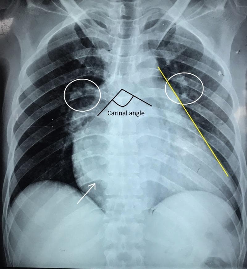 This posteroanterior (PA) chest radiograph illustrates significant cardiomegaly with a cardiothoracic ratio of approximately 70%, commonly associated with advanced valvular disease such as rheumatic mitral stenosis. Annotations highlight pathognomonic radiological signs of left atrial enlargement, including a widened carinal angle (>90 degrees) and a double right heart border (indicated by the white arrow). The left heart border shows characteristic 'straightening' (yellow line) due to the enlargement of the left atrial appendage. Furthermore, the lung fields exhibit cephalization of the pulmonary vasculature (white circles), also known as the 'Antler sign' or 'upturned moustache sign,' which reflects pulmonary venous hypertension and redistribution of blood flow to the upper lobes. The cardiac apex is displaced laterally and downward, suggesting concurrent left ventricular enlargement. This diagnostic image serves as a clinical example of chronic heart failure and congestive changes secondary to severe mitral valve pathology.
