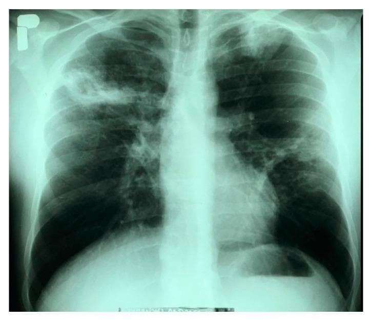 This diagnostic image is a posteroanterior (PA) chest X-ray demonstrating bilateral pulmonary pathology consistent with active tuberculosis. In the right lung, there is a large, heterogeneous infiltrative lesion in the upper field containing a distinct cavitary lesion measuring approximately 35 x 30 mm with irregular borders. The left lung shows an infiltrative opacity at the apex and multiple nodular, fibrous lesions distributed throughout the middle lung field, suggesting a chronic or granulomatous process. The cardiac silhouette appears within normal limits, and the left costophrenic angle is sharp and clear. This radiograph serves as a classic educational example of secondary pulmonary tuberculosis, highlighting hallmark features such as apical predilection, parenchymal infiltration, and cavitation. These findings are clinically significant for the assessment of disease severity and the risk of hemoptysis in patients with Mycobacterium tuberculosis complex infections.